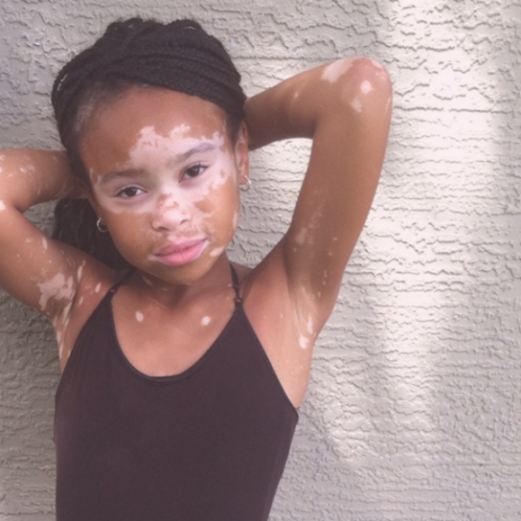 Beleszeretett a divatvilág a 10 éves vitiligós kislányba